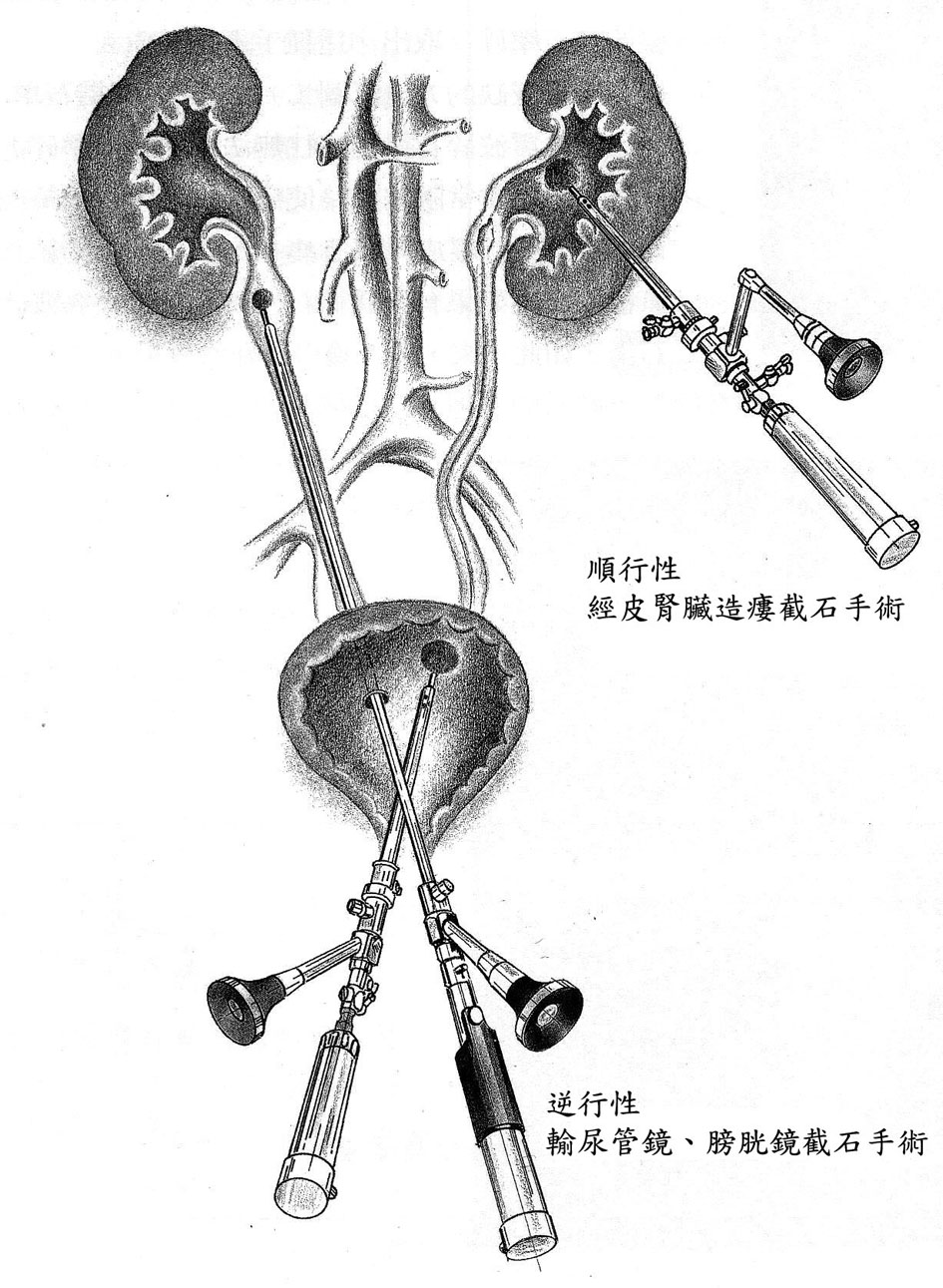 原因 結石 尿 管