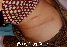 pcnl4.jpg