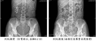 pcnl5.jpg