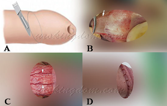 將包皮切出二道淺淺薄薄且平行的環狀傷口