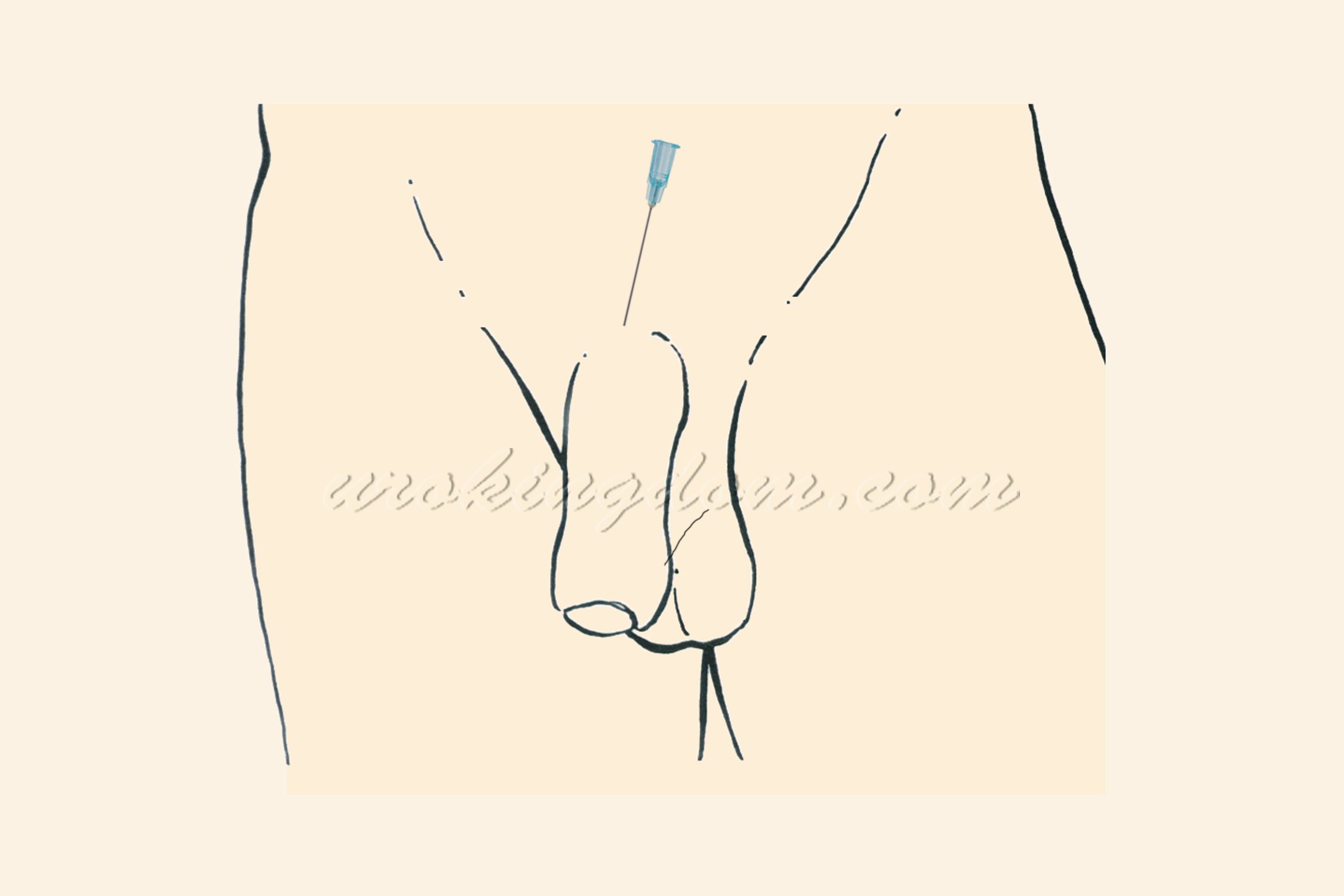 bpc 157 heal nerve damage penile shaft Does BPC-157 Cause Erectile Dysfunction? Evidence and Safe Treatments Bolt Pharmacy BPC 157 Therapy and the
