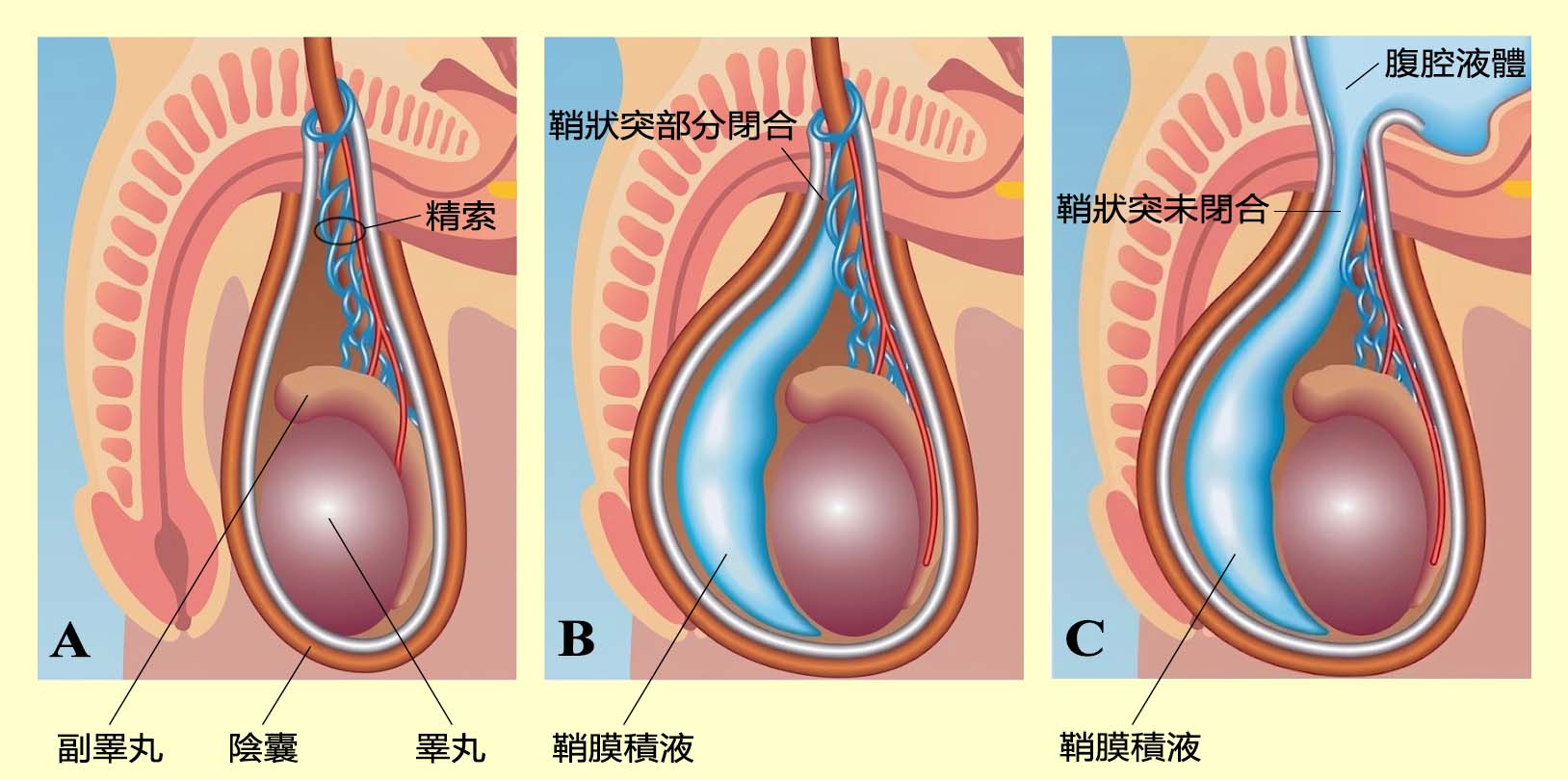 陰嚢水腫切除術（ハイドロセレ切除手術） - 台北の謝泌尿器科クリニック